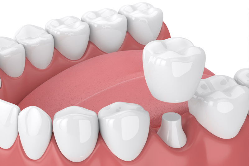 Dental Crowns in Frisco